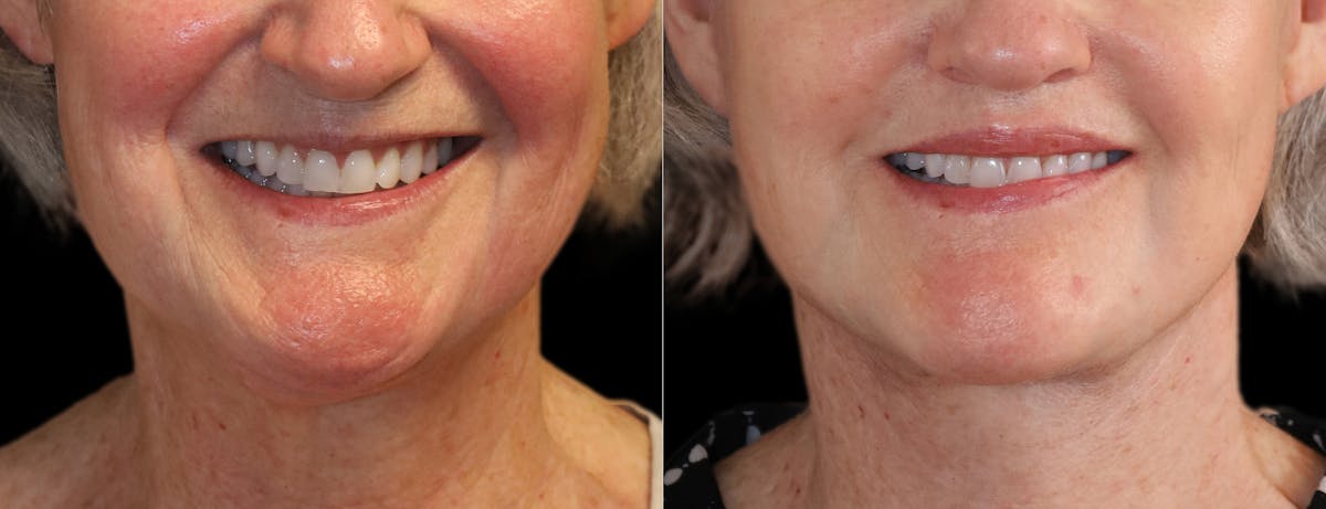 Neck Lift Before & After Gallery - Patient 215457 - Image 5