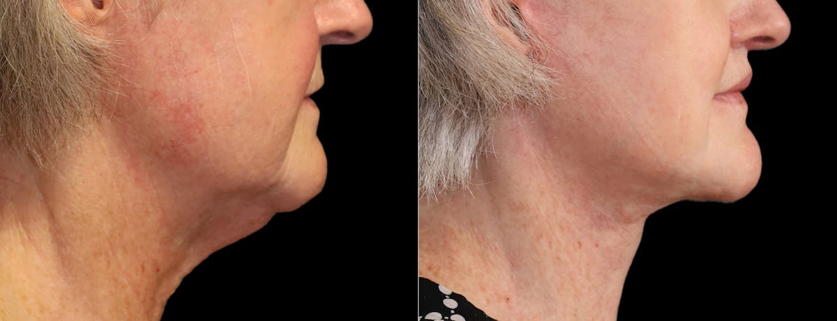 Neck Lift Before & After Gallery - Patient 215457 - Image 11