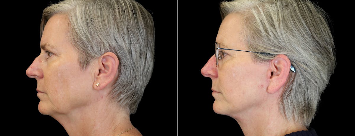 Facelift Before & After Gallery - Patient 412764 - Image 1