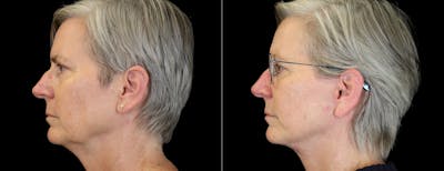 Neck Lift Before & After Gallery - Patient 368690 - Image 1