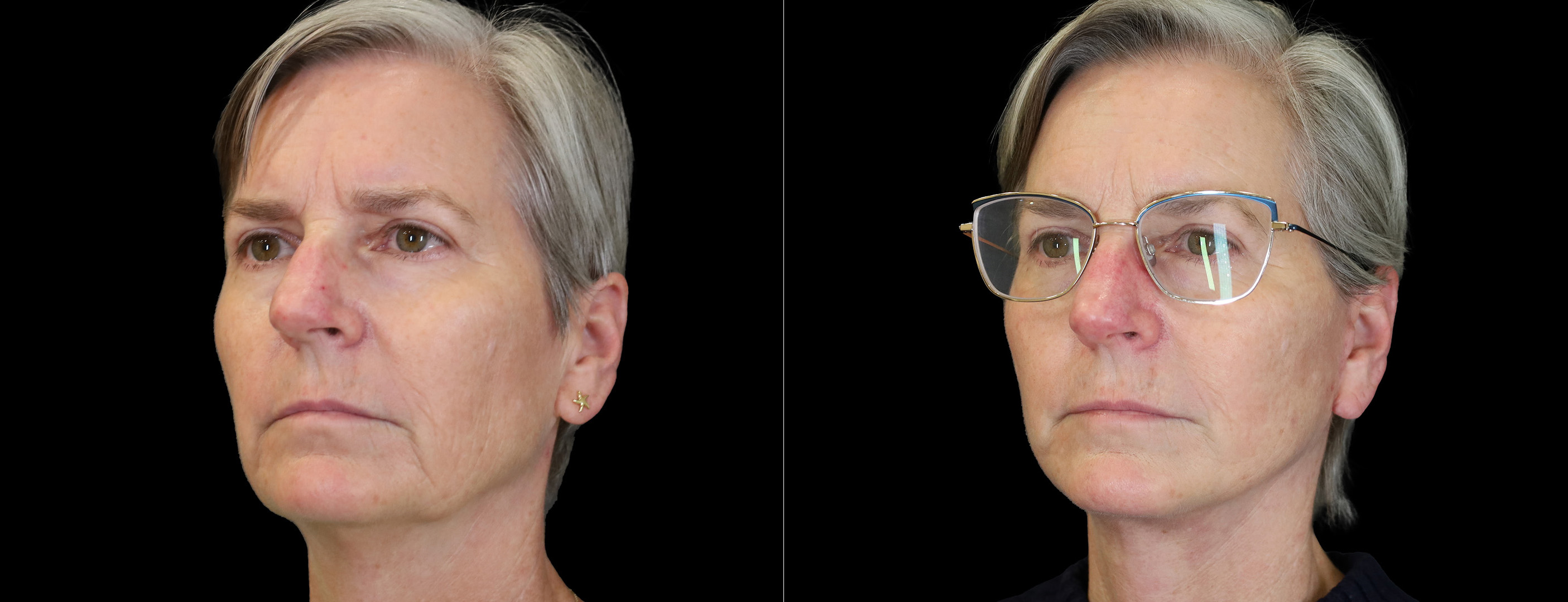 Patient 412764 | Facelift Before & After Photos | Boston Center