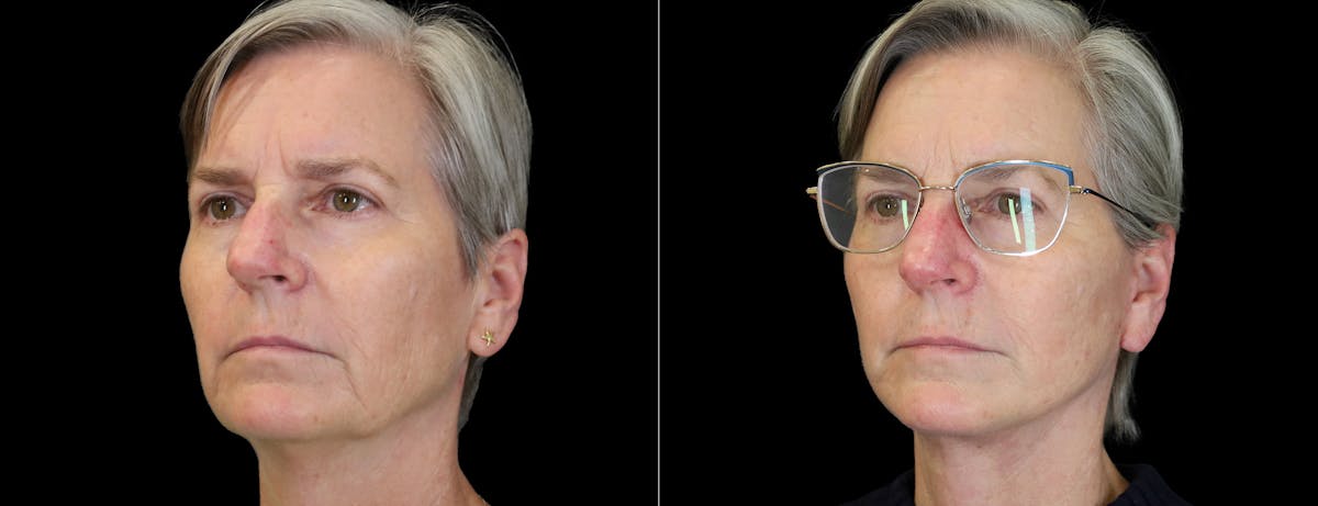 Facelift Before & After Gallery - Patient 412764 - Image 4
