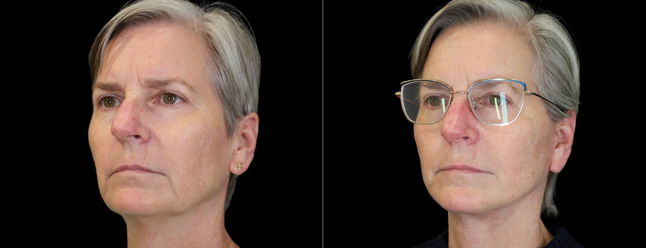 Neck Lift Before & After Gallery - Patient 368690 - Image 4