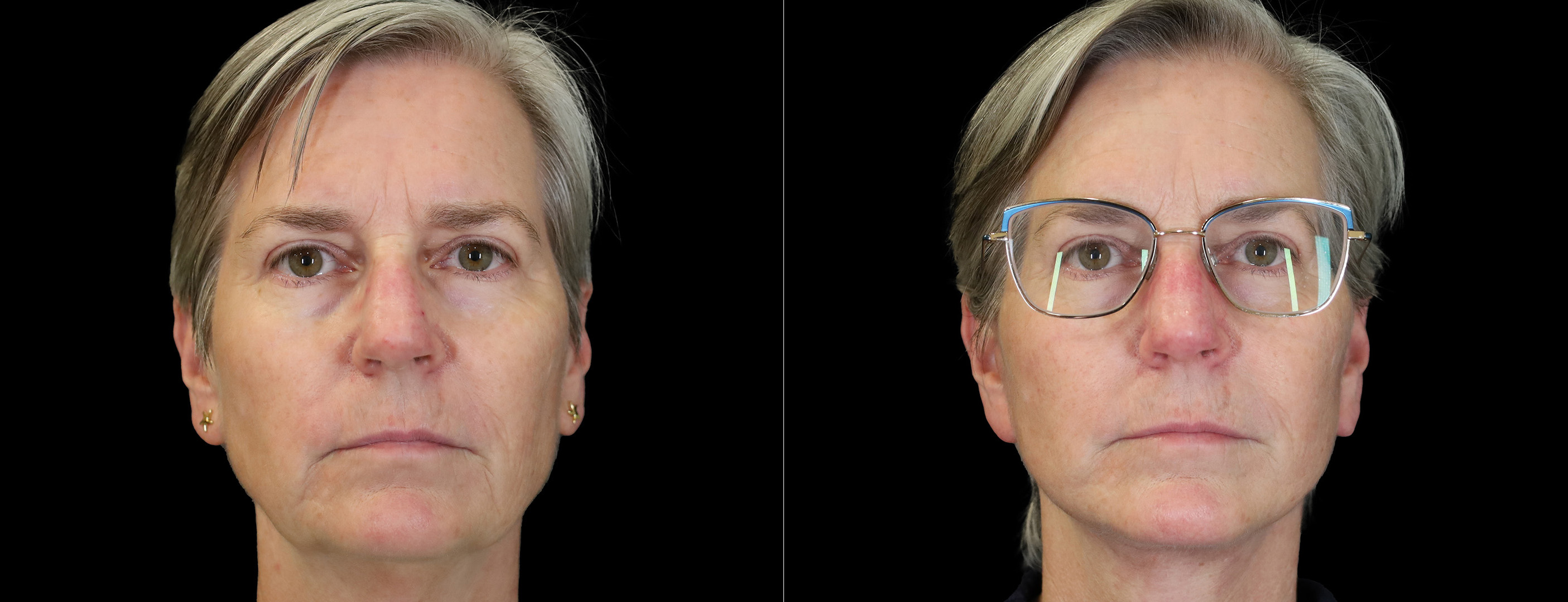 Patient 412764 | Facelift Before & After Photos | Boston Center