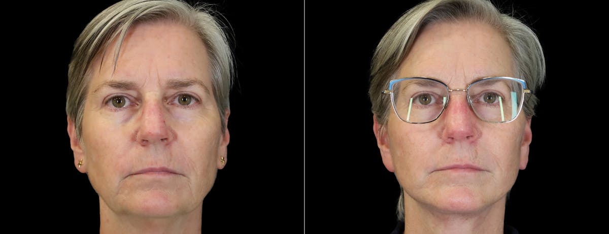 Facelift Before & After Gallery - Patient 412764 - Image 2