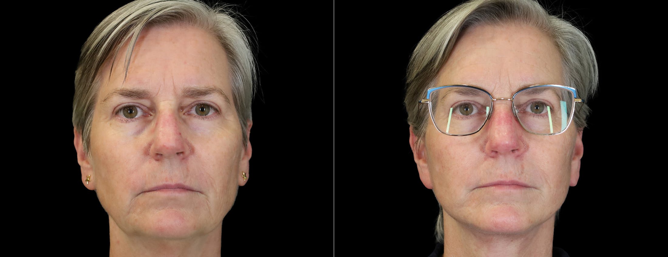 Neck Lift Before & After Gallery - Patient 368690 - Image 2