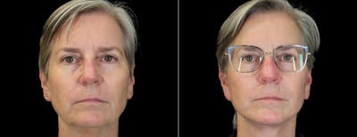 Facelift Before & After Gallery - Patient 412764 - Image 1
