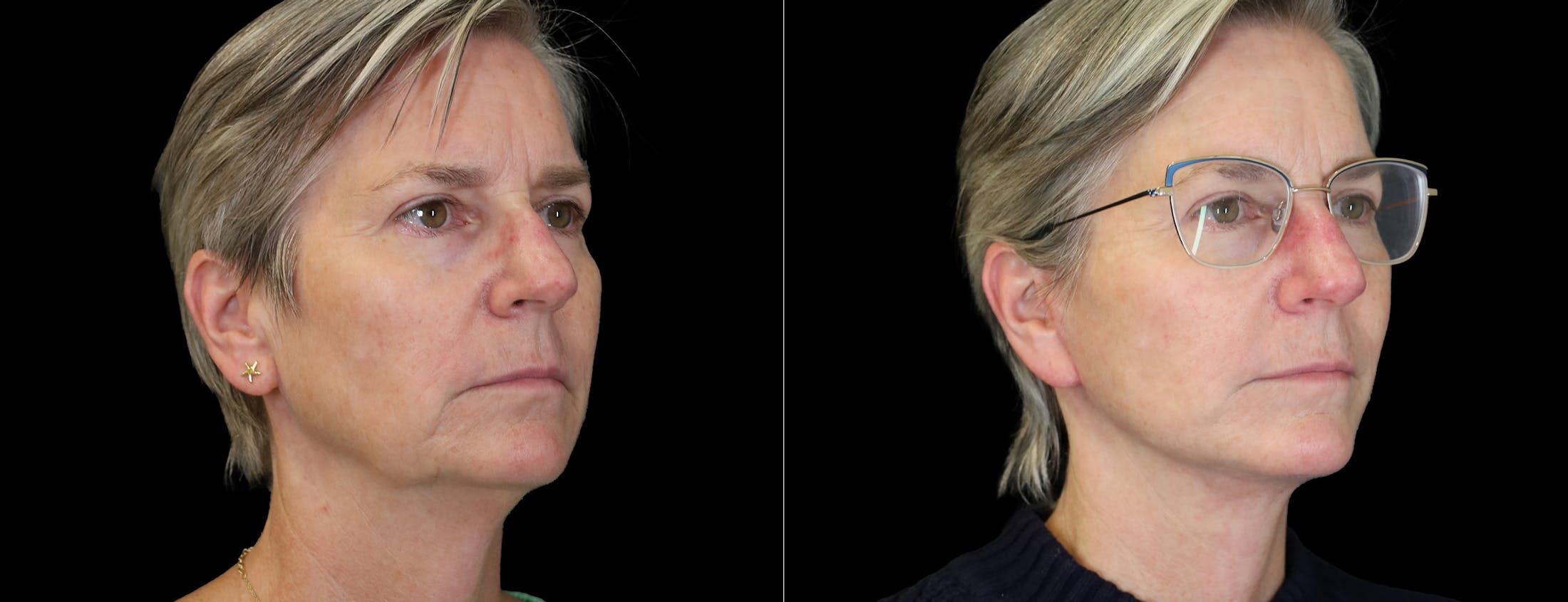 Neck Lift Before & After Gallery - Patient 368690 - Image 3