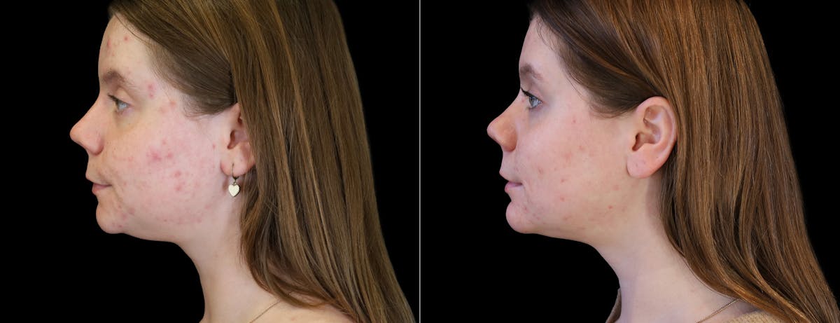 Neck Liposuction Before & After Gallery - Patient 385413 - Image 1