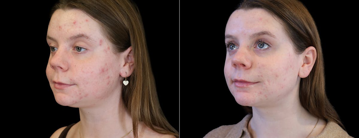Neck Liposuction Before & After Gallery - Patient 385413 - Image 2