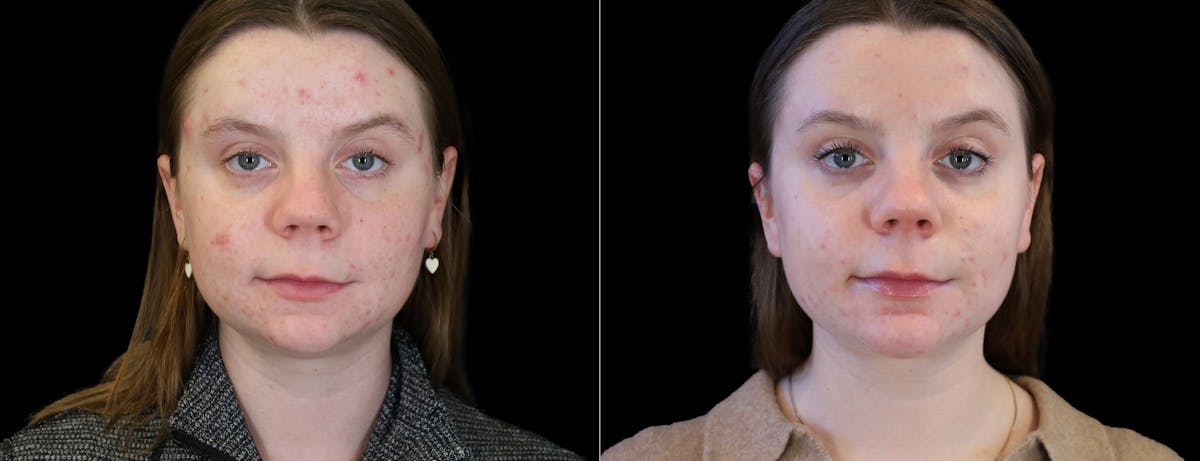 Neck Liposuction Before & After Gallery - Patient 385413 - Image 3