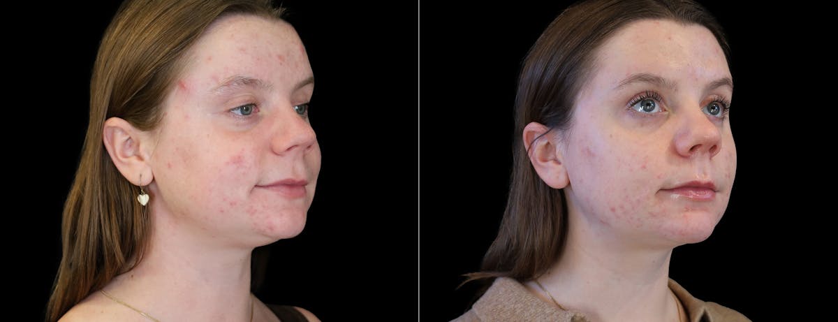 Neck Liposuction Before & After Gallery - Patient 385413 - Image 4