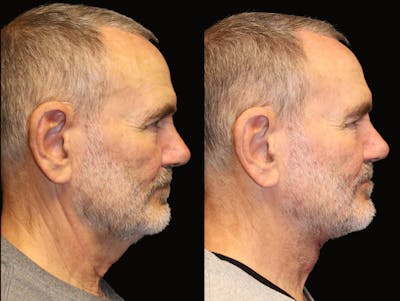 Neck Lift Before & After Gallery - Patient 177905846 - Image 1