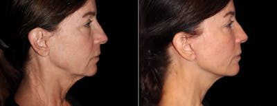 Neck Lift Before & After Gallery - Patient 361518 - Image 1