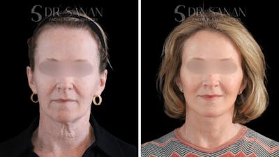 Deep Plane Facelift Before & After Gallery - Patient 174129 - Image 1