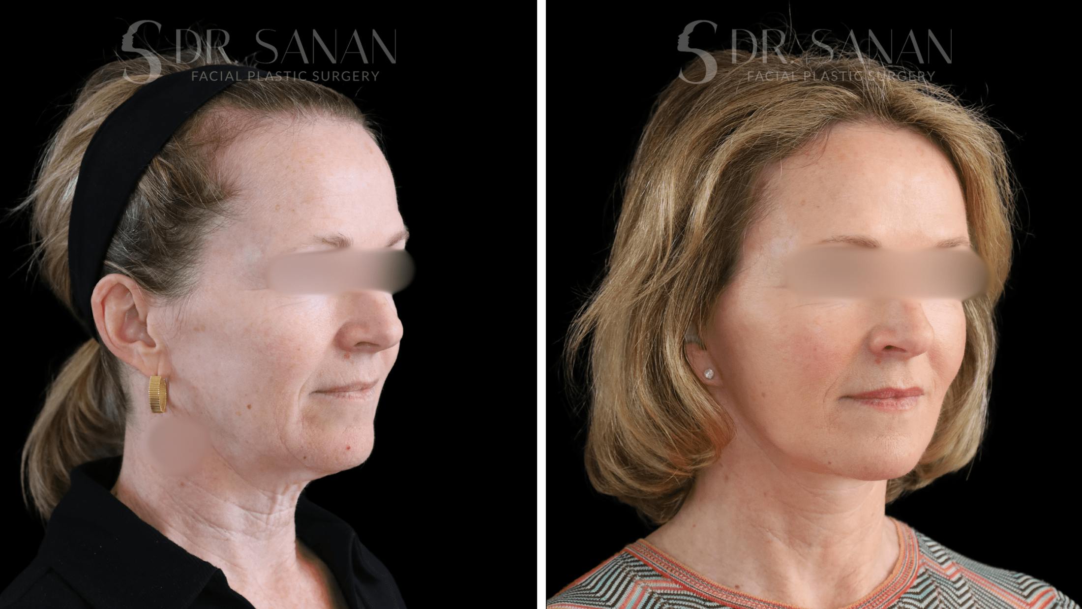 Deep Plane Facelift Before & After Gallery - Patient 174129 - Image 4