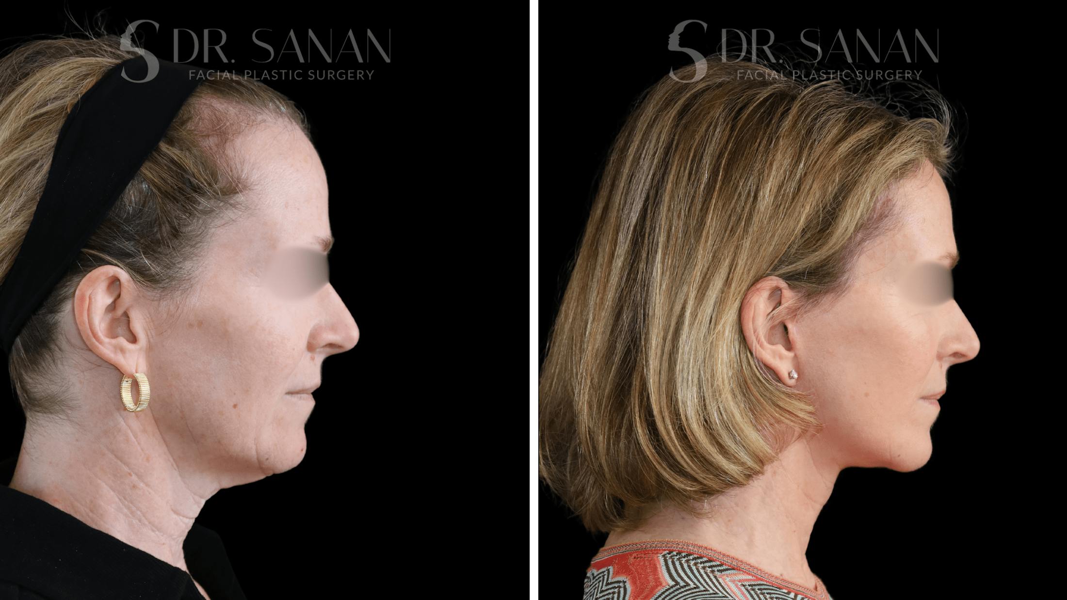 Deep Plane Facelift Before & After Gallery - Patient 174129 - Image 5