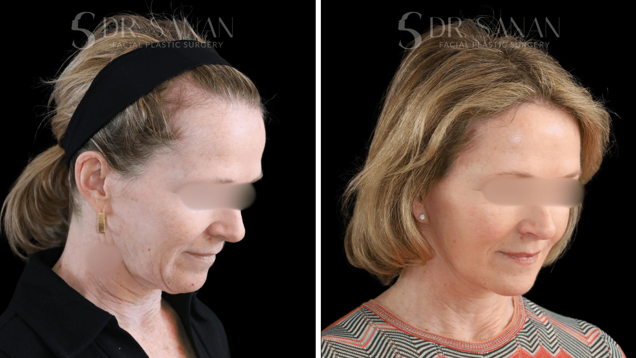 Deep Plane Facelift Before & After Gallery - Patient 174129 - Image 7