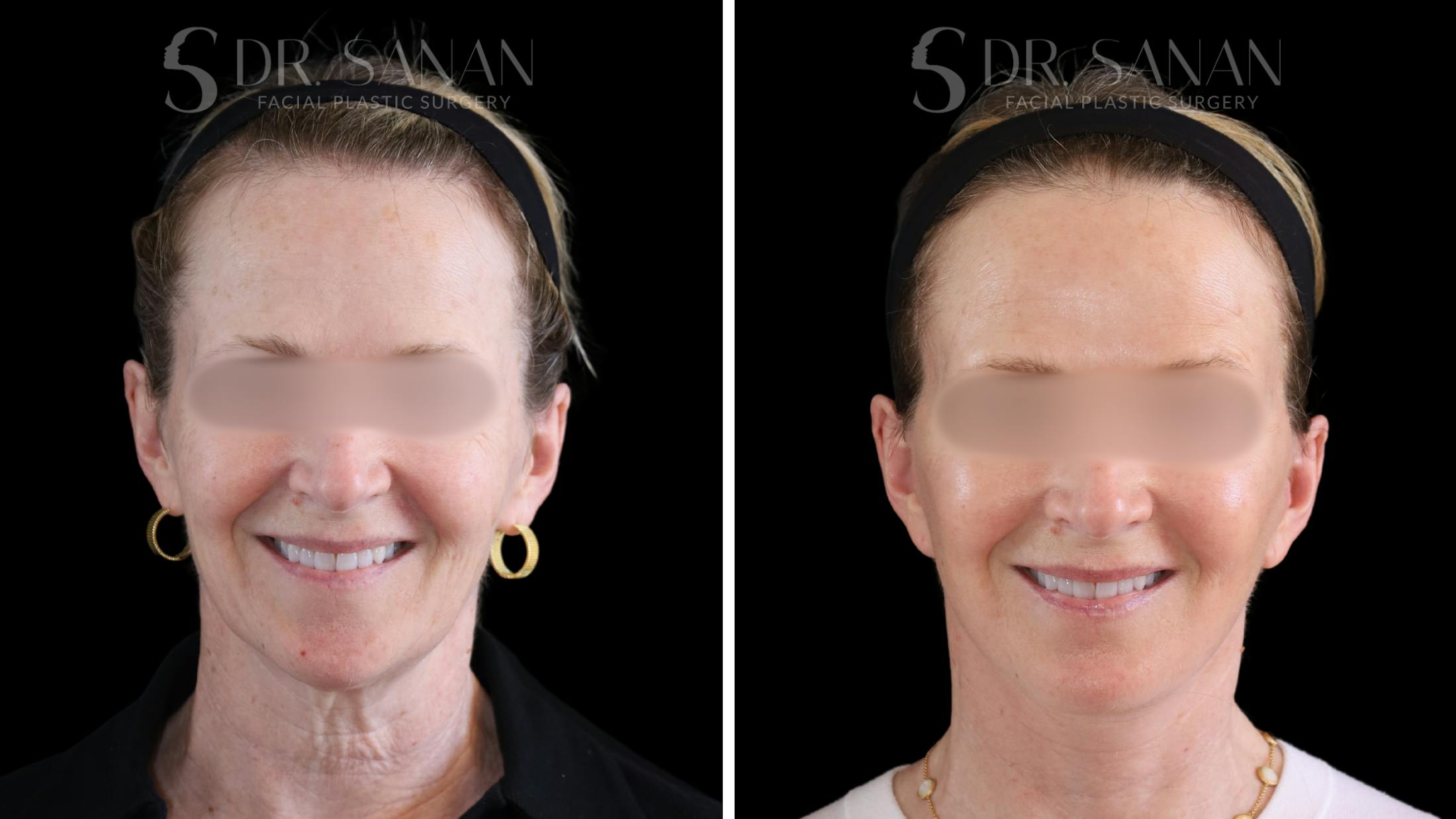 Deep Plane Facelift Before & After Gallery - Patient 174129 - Image 10