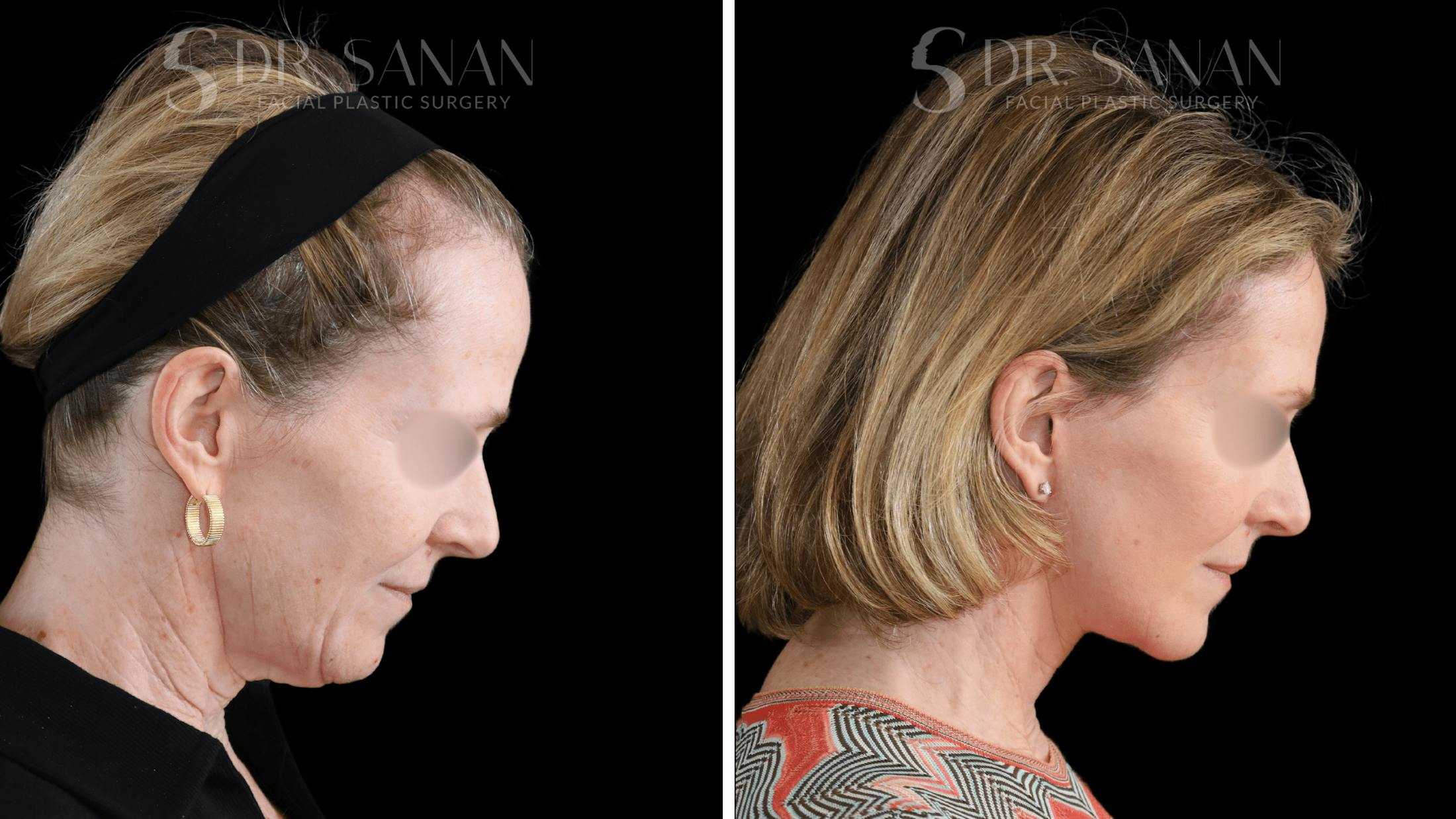 Deep Plane Facelift Before & After Gallery - Patient 174129 - Image 9