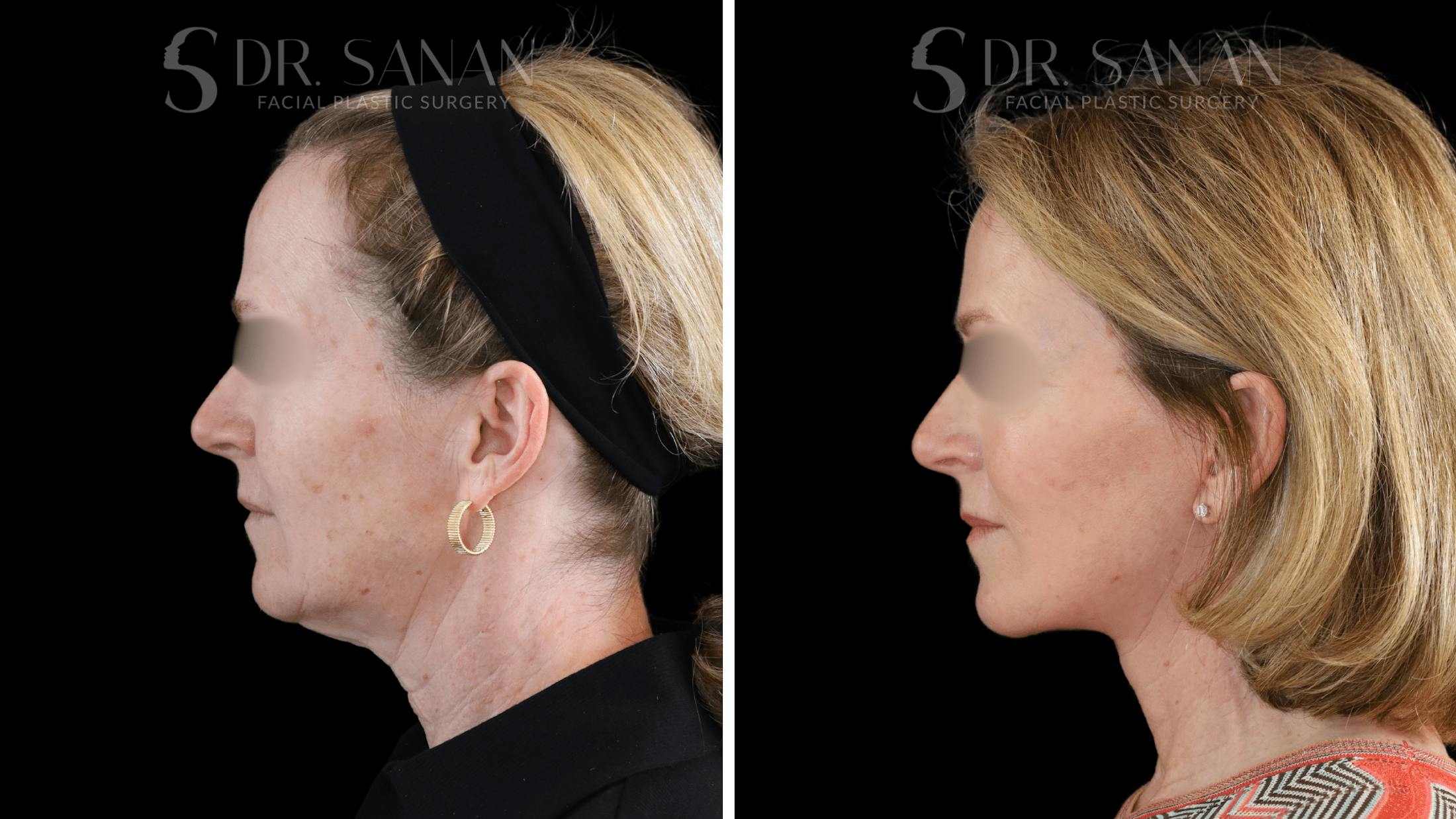 Deep Plane Facelift Before & After Gallery - Patient 174129 - Image 6