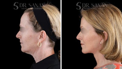 Neck Lift Before & After Gallery - Patient 272160 - Image 1