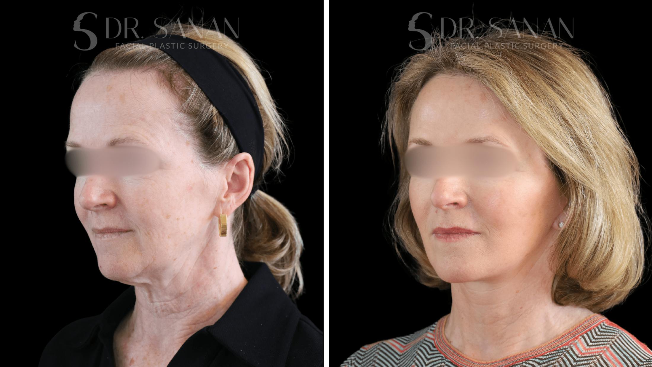 Deep Plane Facelift Before & After Gallery - Patient 174129 - Image 2