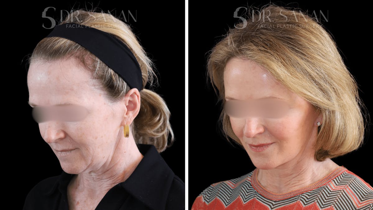 Deep Plane Facelift Before & After Gallery - Patient 174129 - Image 2