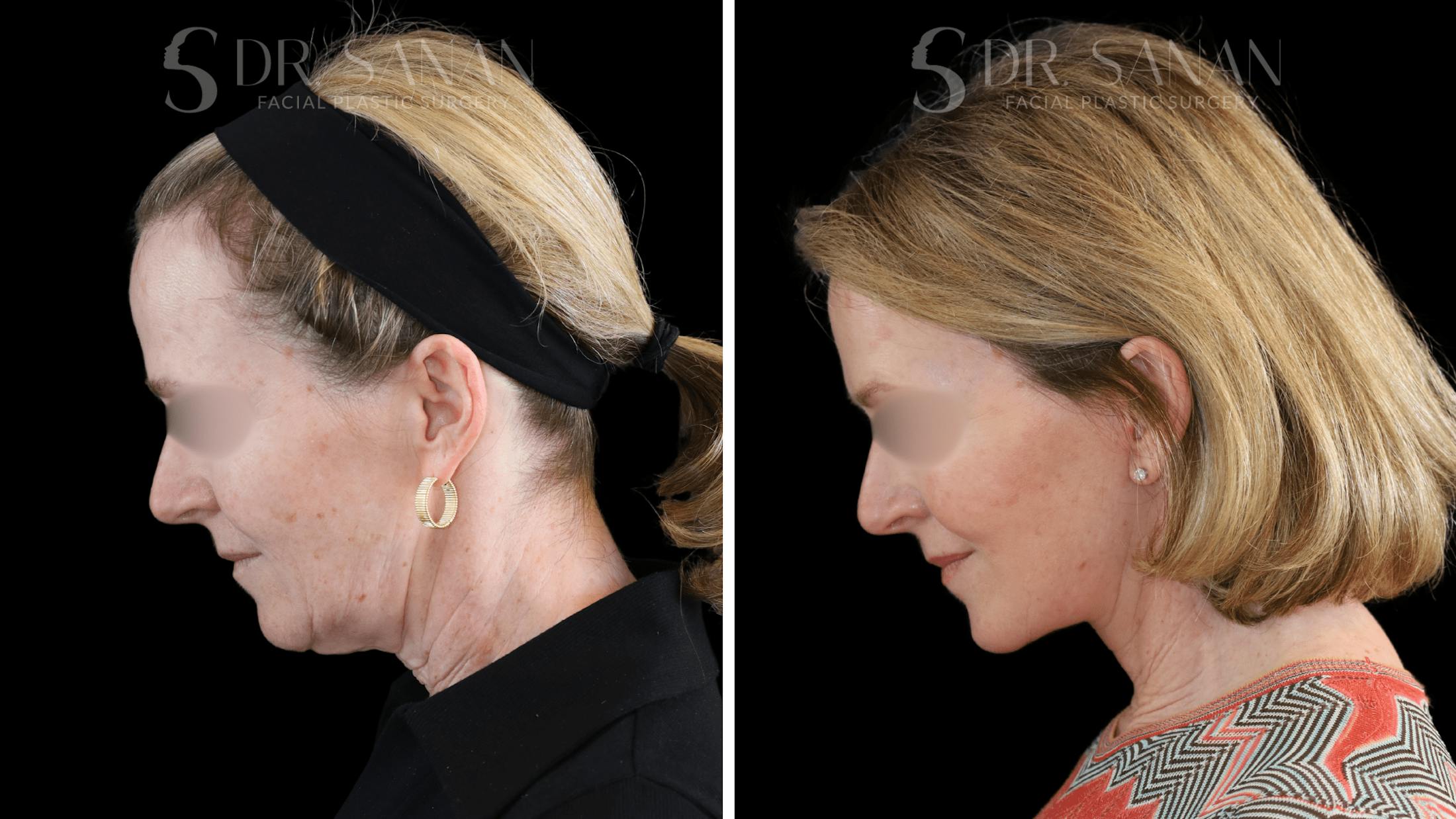 Deep Plane Facelift Before & After Gallery - Patient 174129 - Image 8