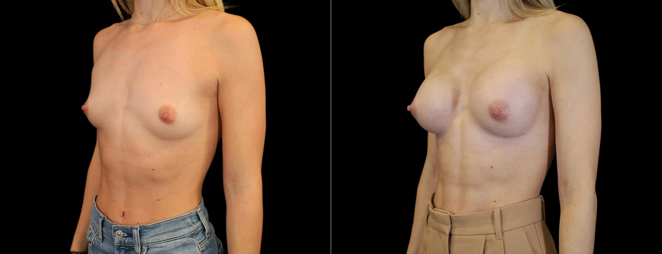 Breast Augmentation Before & After Gallery - Patient 871009 - Image 1