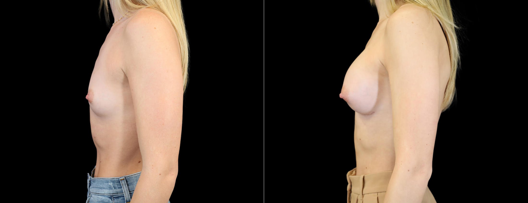 Breast Augmentation Before & After Gallery - Patient 871009 - Image 2