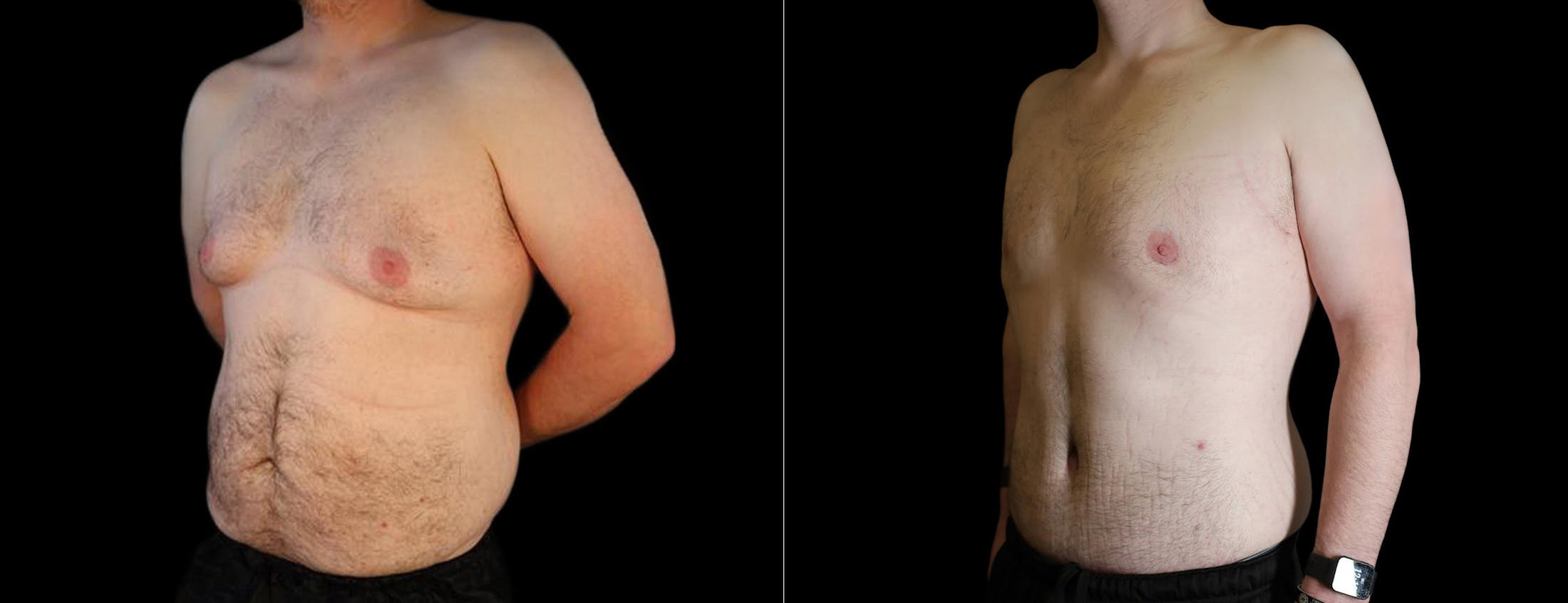 Abdominoplasty (Tummy Tuck) Before & After Gallery - Patient 248009 - Image 1
