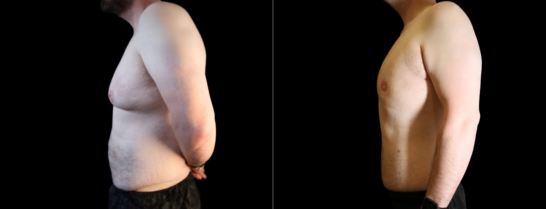 Abdominoplasty (Tummy Tuck) Before & After Gallery - Patient 248009 - Image 2