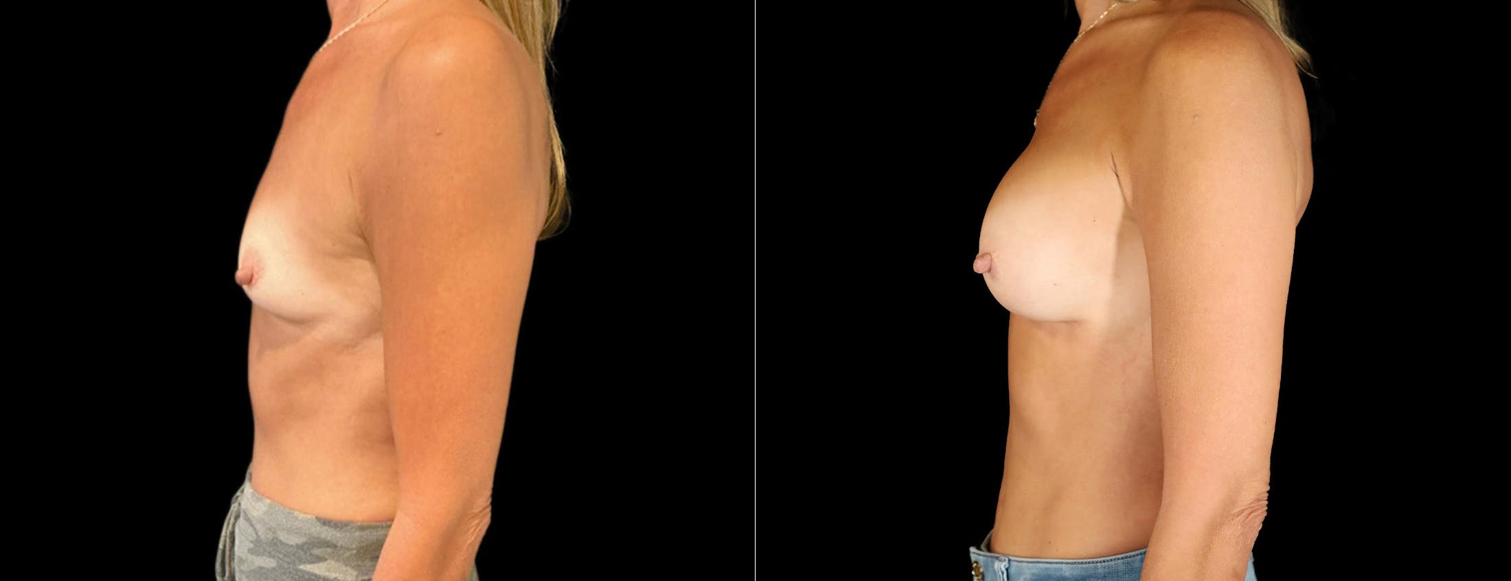 Breast Augmentation Before & After Gallery - Patient 246175 - Image 2