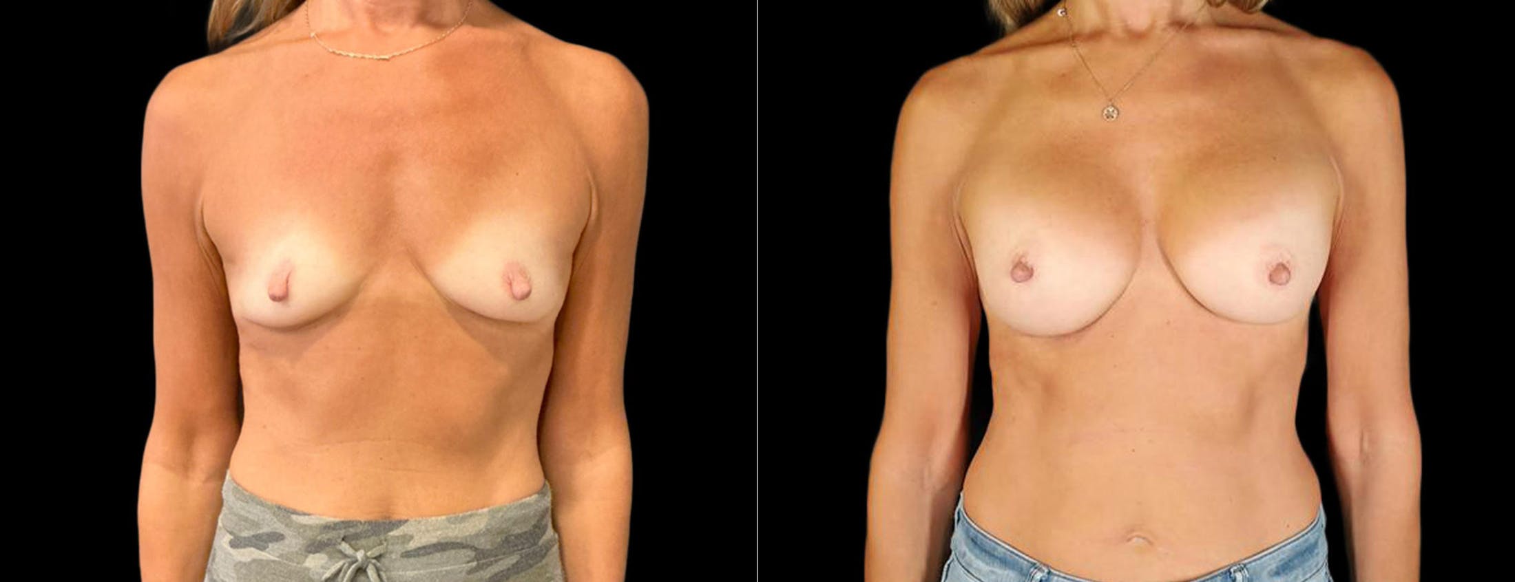 Breast Augmentation Before & After Gallery - Patient 246175 - Image 1