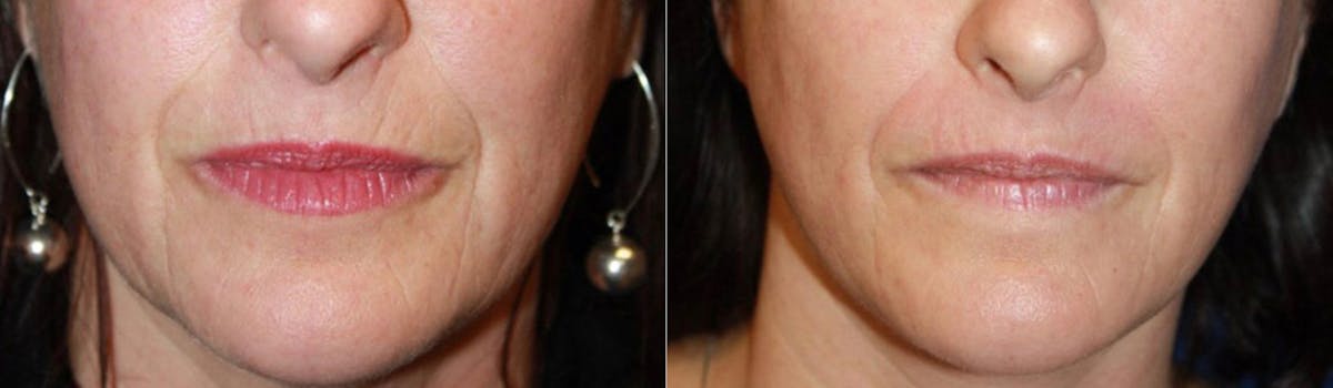 Microneedling Before & After Gallery - Patient 252354 - Image 1