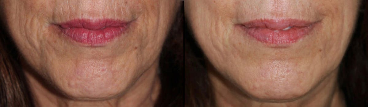 Microneedling Before & After Gallery - Patient 247225 - Image 1