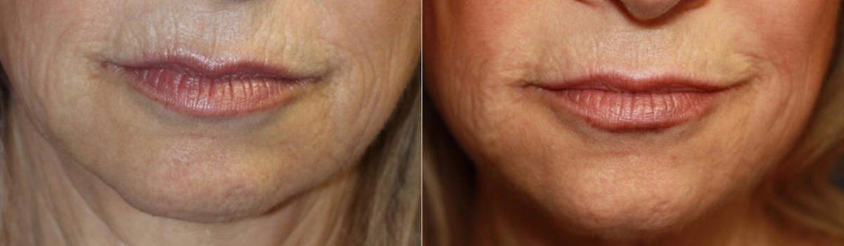 Microneedling Before & After Gallery - Patient 112935 - Image 1