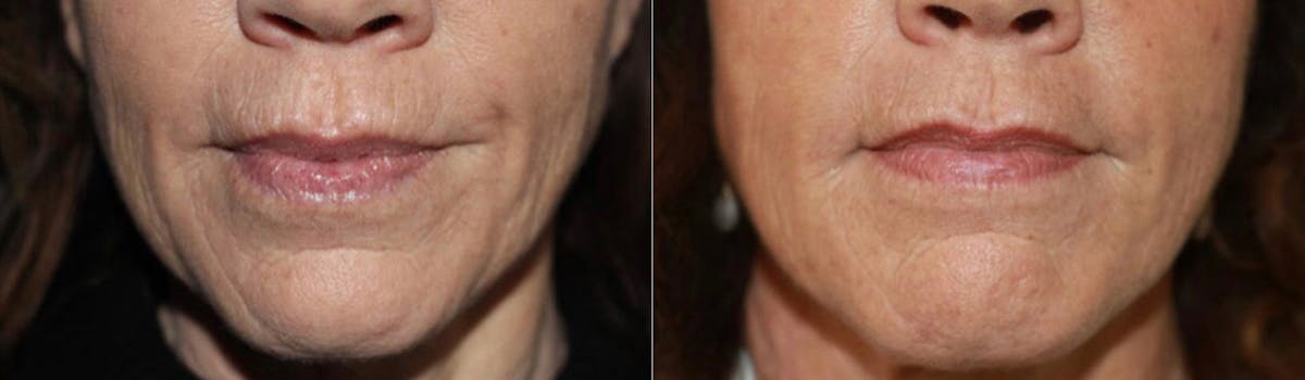 Microneedling Before & After Gallery - Patient 177905317 - Image 1