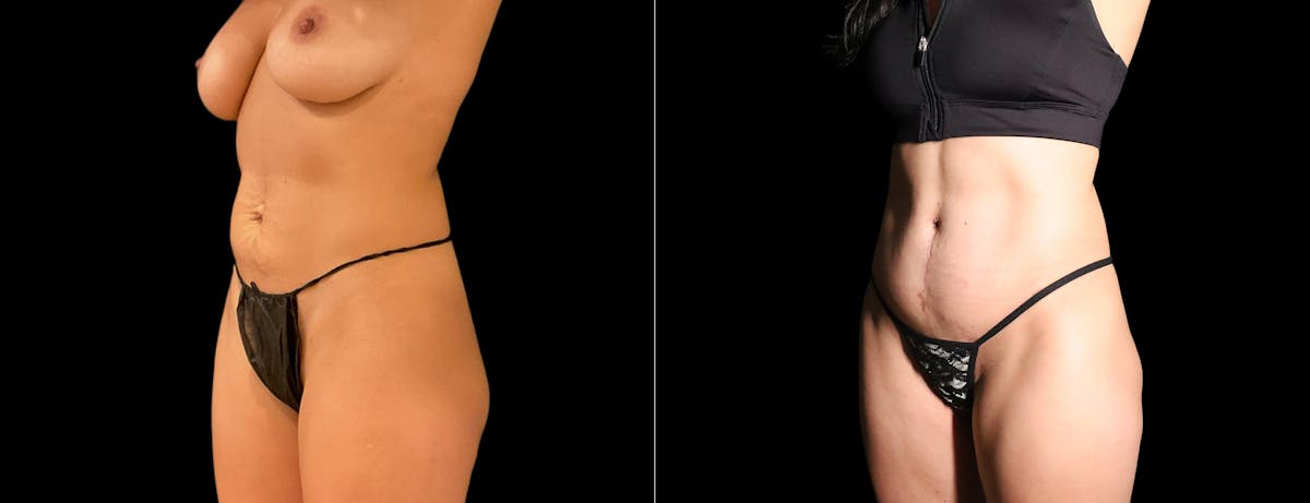 Abdominoplasty (Tummy Tuck) Before & After Gallery - Patient 861980 - Image 2