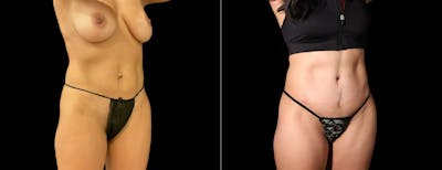 Abdominoplasty (Tummy Tuck) Before & After Gallery - Patient 861980 - Image 1