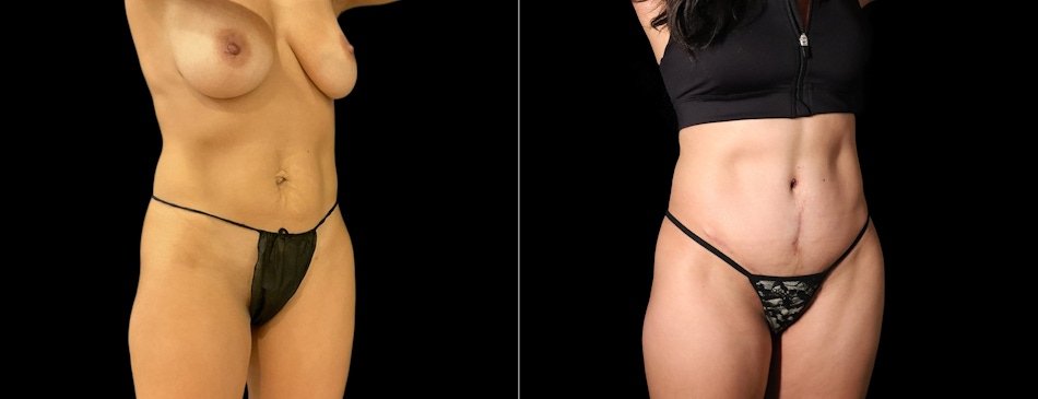 Abdominoplasty (Tummy Tuck) Before & After Gallery - Patient 861980 - Image 1