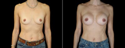 Breast Augmentation Before & After Gallery - Patient 283672 - Image 1