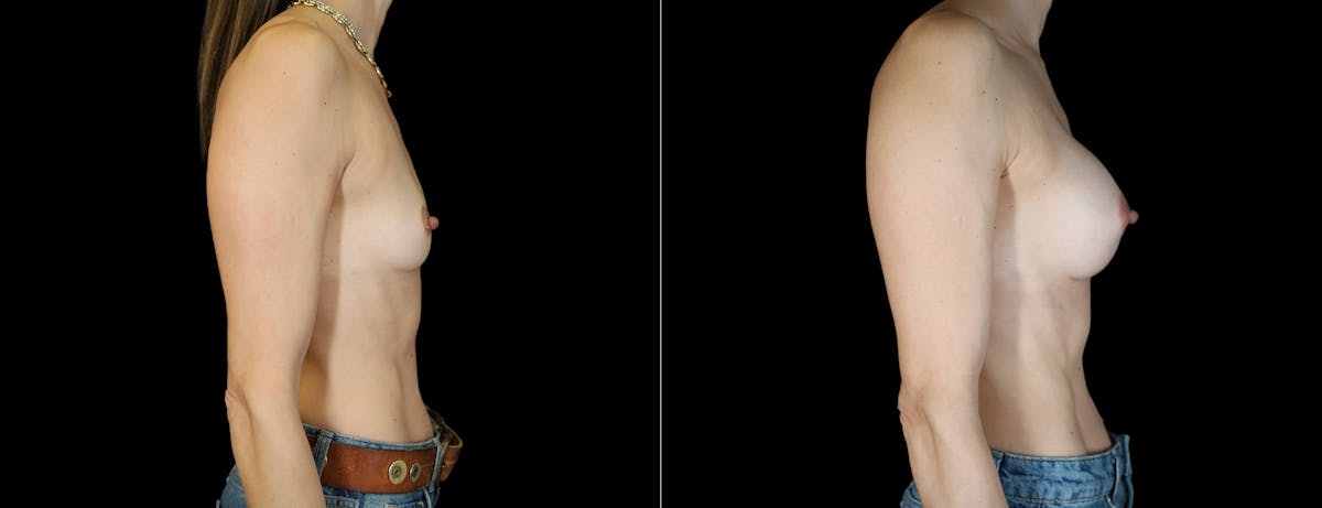 Breast Augmentation Before & After Gallery - Patient 283672 - Image 2