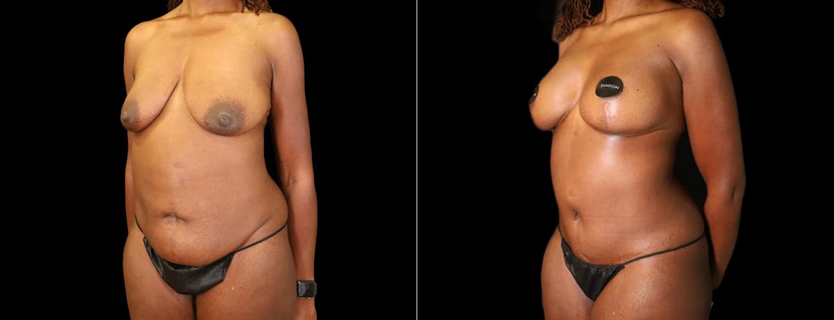 Abdominoplasty (Tummy Tuck) Before & After Gallery - Patient 101190 - Image 2