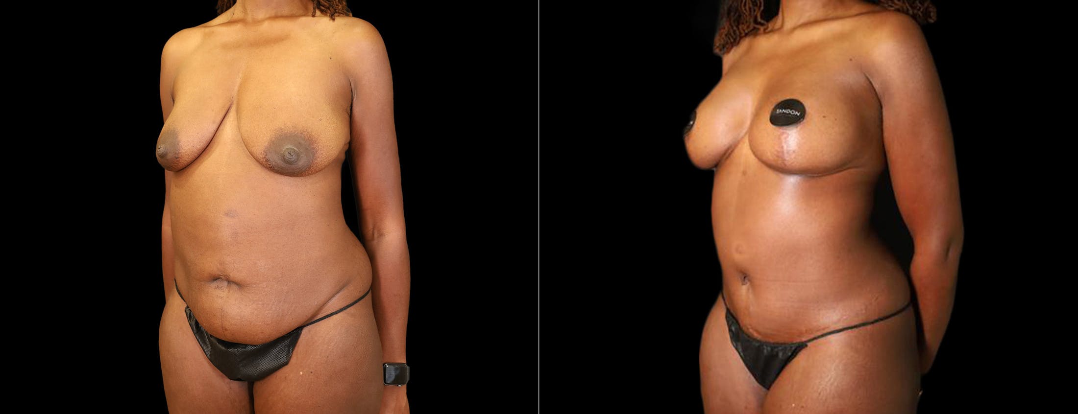 Breast Lift Before & After Gallery - Patient 484352 - Image 2