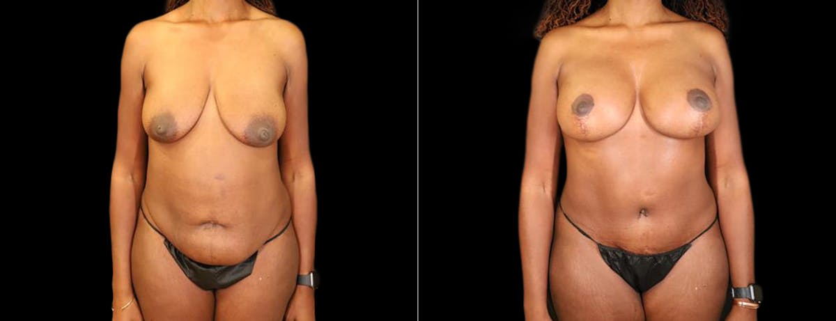 Abdominoplasty (Tummy Tuck) Before & After Gallery - Patient 101190 - Image 1