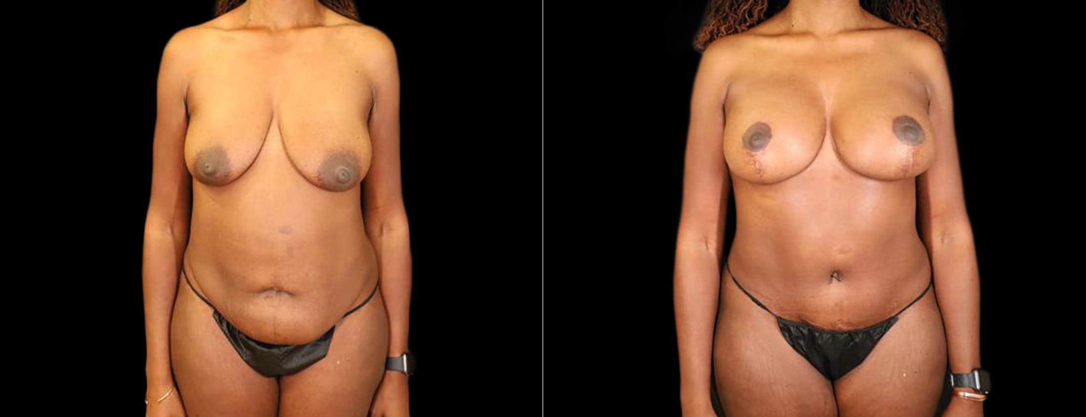 Breast Lift Before & After Gallery - Patient 484352 - Image 1