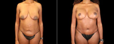 Abdominoplasty (Tummy Tuck) Before & After Gallery - Patient 101190 - Image 1