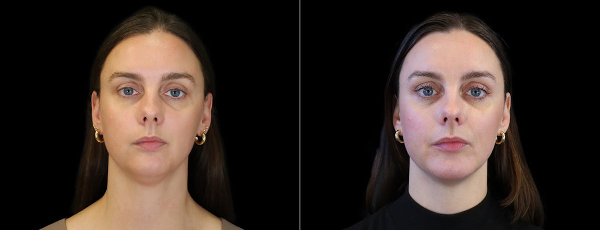 Chin Augmentation Before & After Gallery - Patient 147726 - Image 2